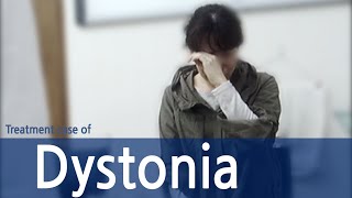 Generalized spasmodic dystonia  Spasmodic Torticollis  Dystonia  사경증 치료사례  근긴장이상증 [upl. by Nosylla]