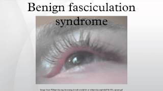 Benign fasciculation syndrome [upl. by Netsud258]