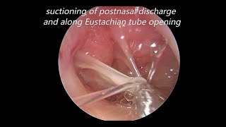 Endoscopic Myringotomy Suctioning of Middle Ear Mucous and Grommet Insertion [upl. by Suhcnip]