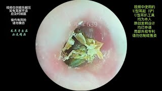 采耳哥Fine operation to clean the hard earwax on the eardrum  639 [upl. by Ettelra]