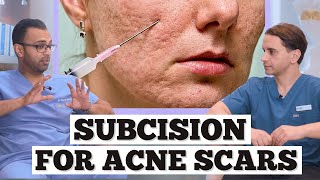 Subcision Acne Scars  Minor Surgery For Acne Scarring  Dr Somji amp Dr Solomon Explain Acne Scars [upl. by Benzel]