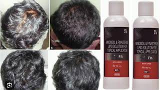 Morr F 5 Solution MINOXIDIL amp FINASTERIE LIPID SOLUTION FOR TOPICAL APPLICATION [upl. by Ayital]