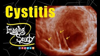 Cystitis  Ultrasound  3D  Case 228 [upl. by Sualkin]