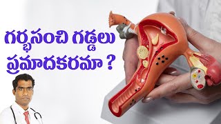 గర్భసంచి గడ్డలు ప్రమాదకరమా  Are uterinefibroids dangerous [upl. by Einrae8]