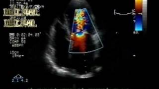 MS different aspectsmitral stenosis with leaflets borders calcification [upl. by Cirillo829]