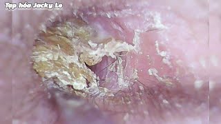 Ear Wax Removal 118 The Earwax Is So Dry And Sticky That It Hurts My Ears  Ear Cleaning ASMR [upl. by Aronal]