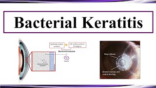 Bacterial Keratitis [upl. by Ejrog553]