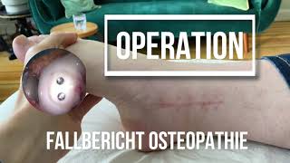 Operation des Sprunggelenks  osteochondrosis dissecans Falllbericht [upl. by Ayotnom]