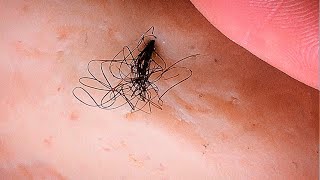 Removal of ingrown hair [upl. by Trilby261]