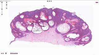 Seborrheic Keratosis Including Variants  Histopathology [upl. by Sollows]