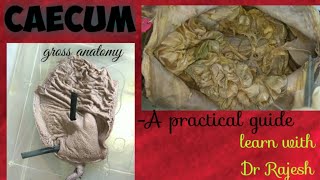 CAECUM  Specimen demo [upl. by Jacobsen]