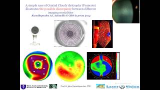 Not Narrated Cornea crosslinking for forme fruste keratoconus Is it indicated [upl. by Snyder376]