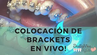 Colocación de Brackets en VIVO  Putting on Braces  LIVE [upl. by Cusick]