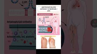 Antiphospholipid Antibody Syndrome [upl. by Deach]