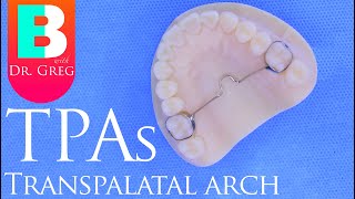 Braces TPA Transpalatal Arch [upl. by Netnerb]