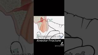 Management of Alveolar Fracture [upl. by Anikehs]