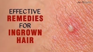 10 Effective Remedies For Ingrown Hair [upl. by Plossl796]