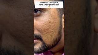 Get Rid Of Acne amp Dark SpotsAcne amp Pigmentation Removal PackGet Spotless Skin Acne skincare [upl. by Namrej]