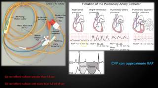 Invasive Monitoring Series Episode 3 Interpreting CVP and Art Lines with Pulmonary Dysfunction [upl. by Aicertal]