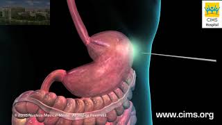 PEG Feeding Placement Tube  CIMS Hospital [upl. by Abana]