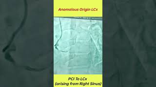 Anomalous Origin Left Circumflex Artery Arising From Right Sinus anomalous coronary artery origins [upl. by Bessie258]