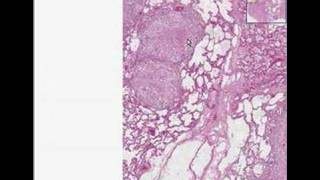 Histopathology Lung Tuberculosis [upl. by Cicenia921]