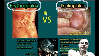 Erythroplakia Vs Leukoplakia Symptoms causes risk of malignancies [upl. by Masuh]