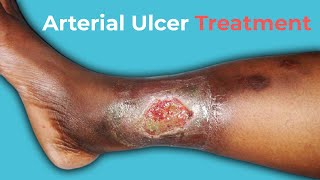 What Are Arterial Ulcers Arterial Ulcer Treatment [upl. by Narik532]