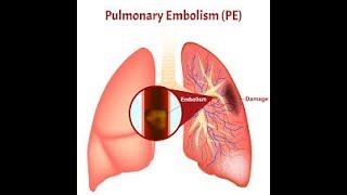 PULMONER EMBOLİDE WELLS VE PERC SKORU KULLANIMI [upl. by Charleton]