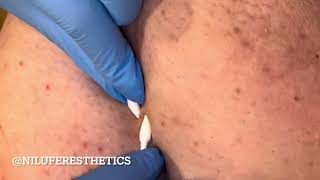 Satisfying Body Extractions Ingrown Hair Extractions [upl. by Teik456]