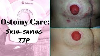 Ostomy Care Tip Saving your skin from abrasion [upl. by Hau574]