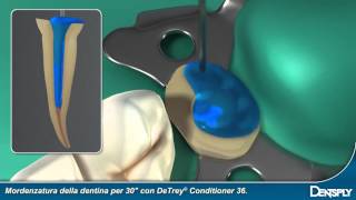 Dentsply CoreampPost System [upl. by Atnohs]