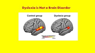 Dyslexia Some Background Information Andrew P Johnson PhD [upl. by Cates955]