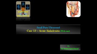 Ultrasound Case 13  Acute Sialadenitis Web case [upl. by Jb]