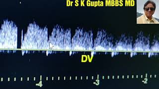 Ductus Venosus Flow Waves explained First Trimester Pregnancy Ultrasound [upl. by Azeel386]