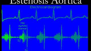 Soplo de la Estenosis Aórtica [upl. by Ennazus]