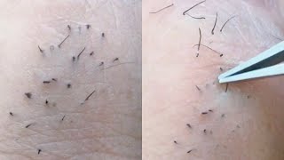 Ingrown hair removal satisfying [upl. by Nahtaneoj]