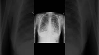 Linfangitis carcinomatosa radiografia radiologia radiology medicina pulmones torax viral [upl. by Ardnat471]