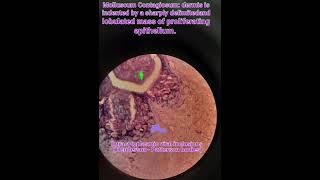 Molluscum contagiosumhistologyskininfectionspathologymedical [upl. by Dyana23]