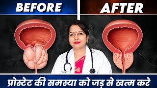 Prostate enlargement प्रोस्टेट की समस्या को कम करने के 5 घरेलू उपाय Prostate Homoeopathic medicine [upl. by Enairda695]