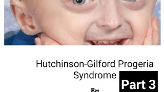 Treatment of Hutchinson Gilford progeria syndrome  lonafarnib [upl. by Anaujit]