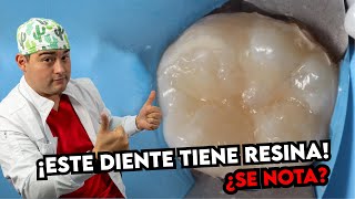 RESINAS DENTALES ANTES Y DESPUES ¿COMO DEBE QUEDAR UNA RESTAURACIÓN DENTAL CORRECTAMENTE [upl. by Origra]