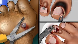 ASMR Animation Screw nail removal  Toenail Treatment [upl. by Yortal580]