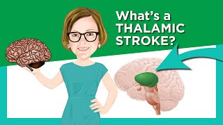 Thalamic Stroke [upl. by Burchett]