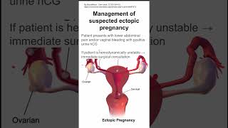 Management of suspected ectopic pregnancy [upl. by Neersin]