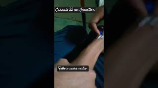 22 no cannula insertion [upl. by Ahseen]