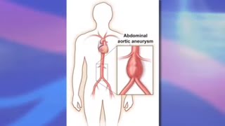 Risks and Benefits of Endovascular Abdominal Aortic Aneurysm Repair EVAR [upl. by Afesoj]