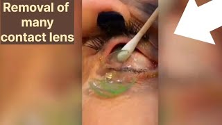 Removal of many contact lens  patient eyes record medical shorts [upl. by Scheld]