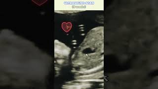 1st Heart Beat on Ultrasound 👶🏻💖  Fetal heartbeat  Heart embryology heart heartbeat ultrasound [upl. by Anaoj]