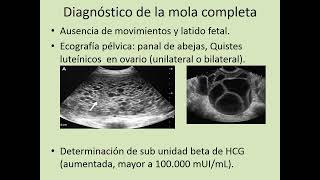 enfermedad trofoblastica dr dueñas [upl. by Euqinom]